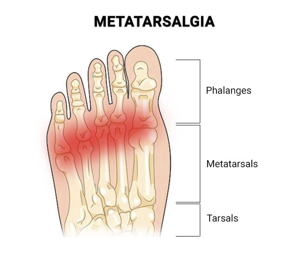 condition metatarsalgia